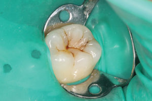 Koferdam – do izolacji zęba leczonego od środowiska jamy ustnej. Chirurg stomatolog Żary, Żagań
