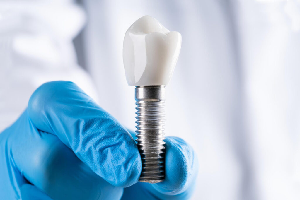 Zalety implantów zębowych: dlaczego warto zainwestować w nowy uśmiech?