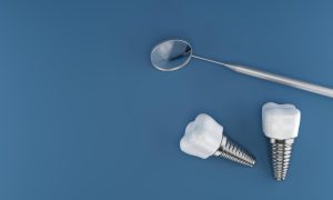 Jak zbudowany jest implant zębowy? Jak zbudowany jest implant zębowy?